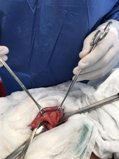 Cirugía de apendicitis en niños